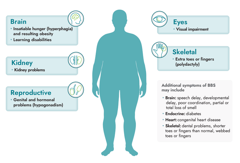 Body diagram identifying BBS symptoms in the brain, kidney, eyes, heart, reproductive, endocrine, and skeletal systems