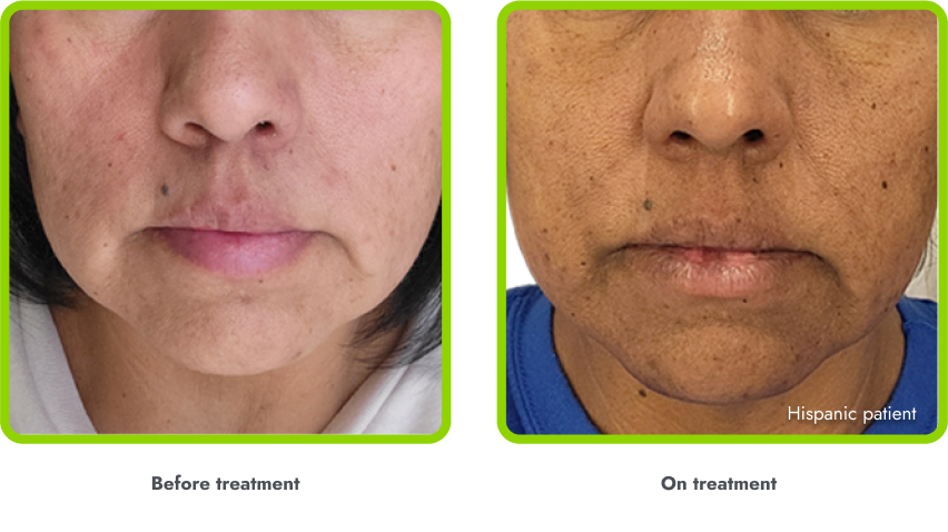 Examples of hyperpigmentation (before and during
treatment with IMCIVREE