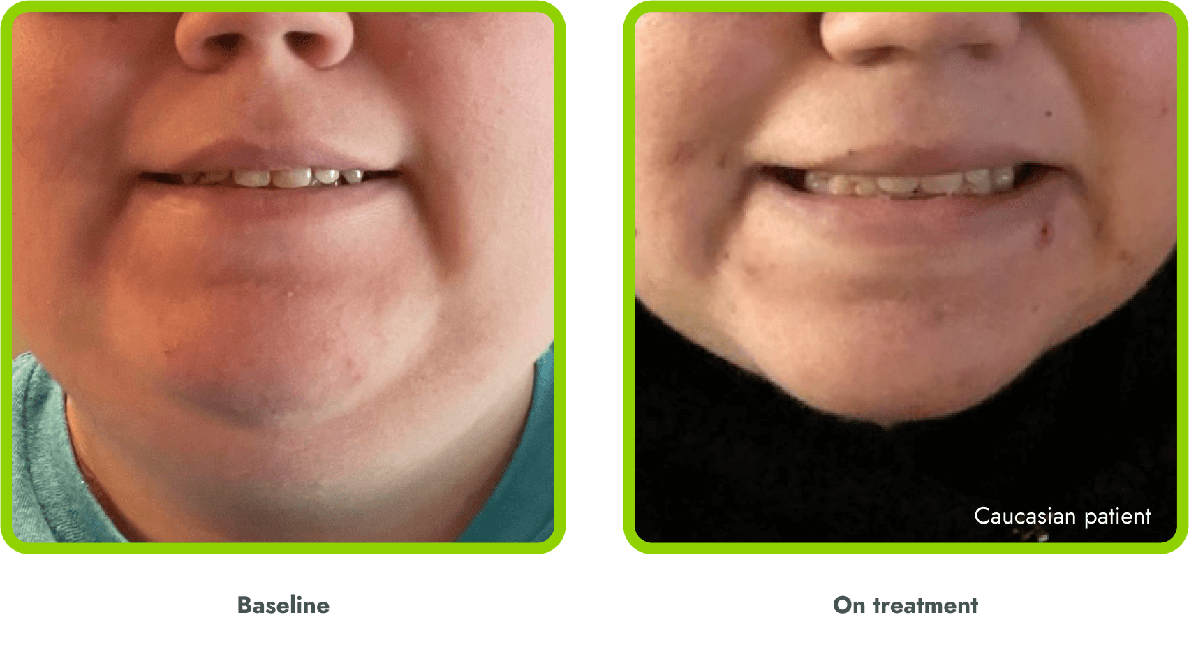 Examples of hyperpigmentation (before and during treatment with IMCIVREE)