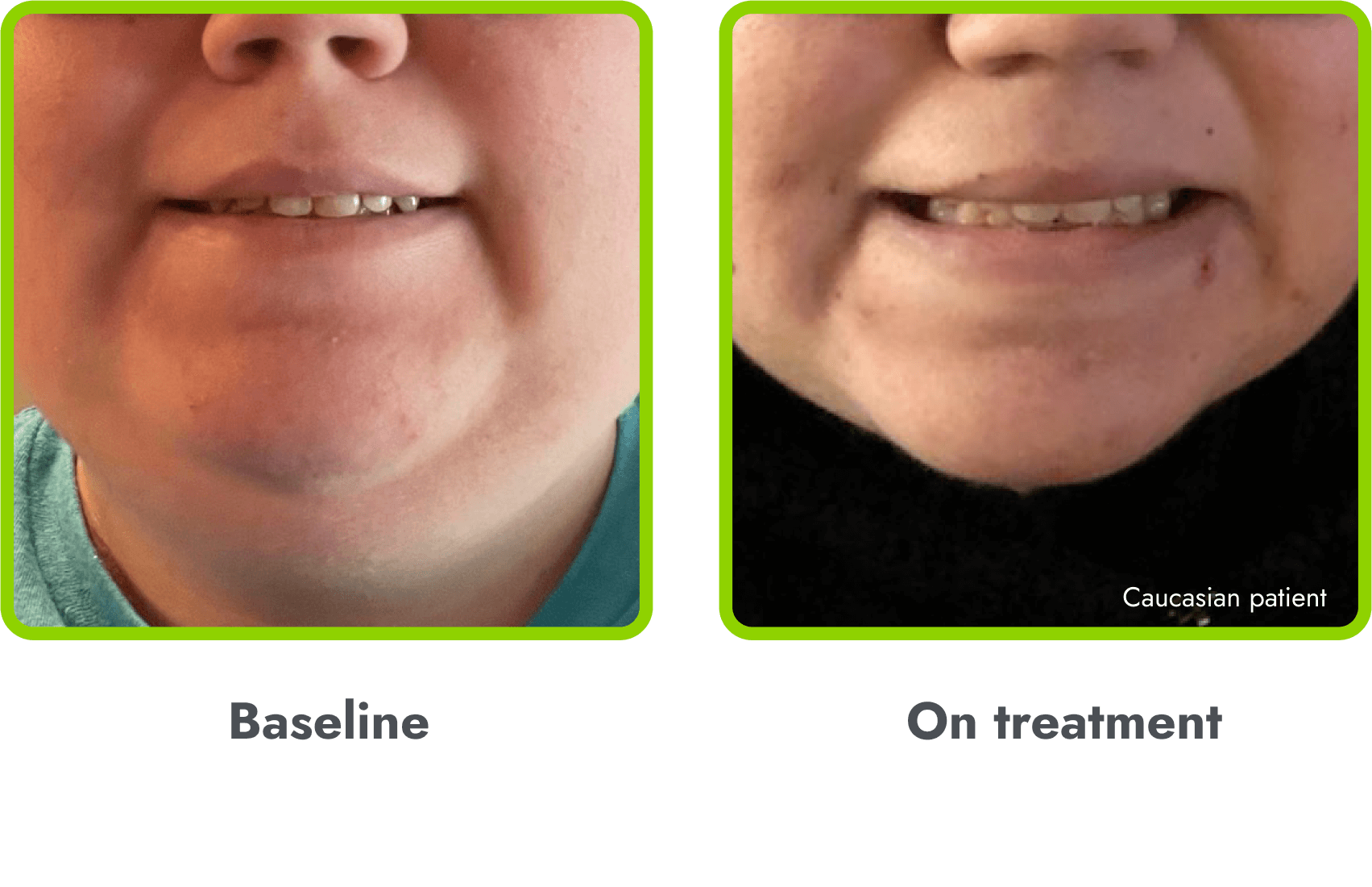 Examples of hyperpigmentation (before and during treatment with IMCIVREE)